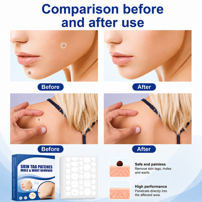 Ovelisy® Skin tag patches mole & wart remover