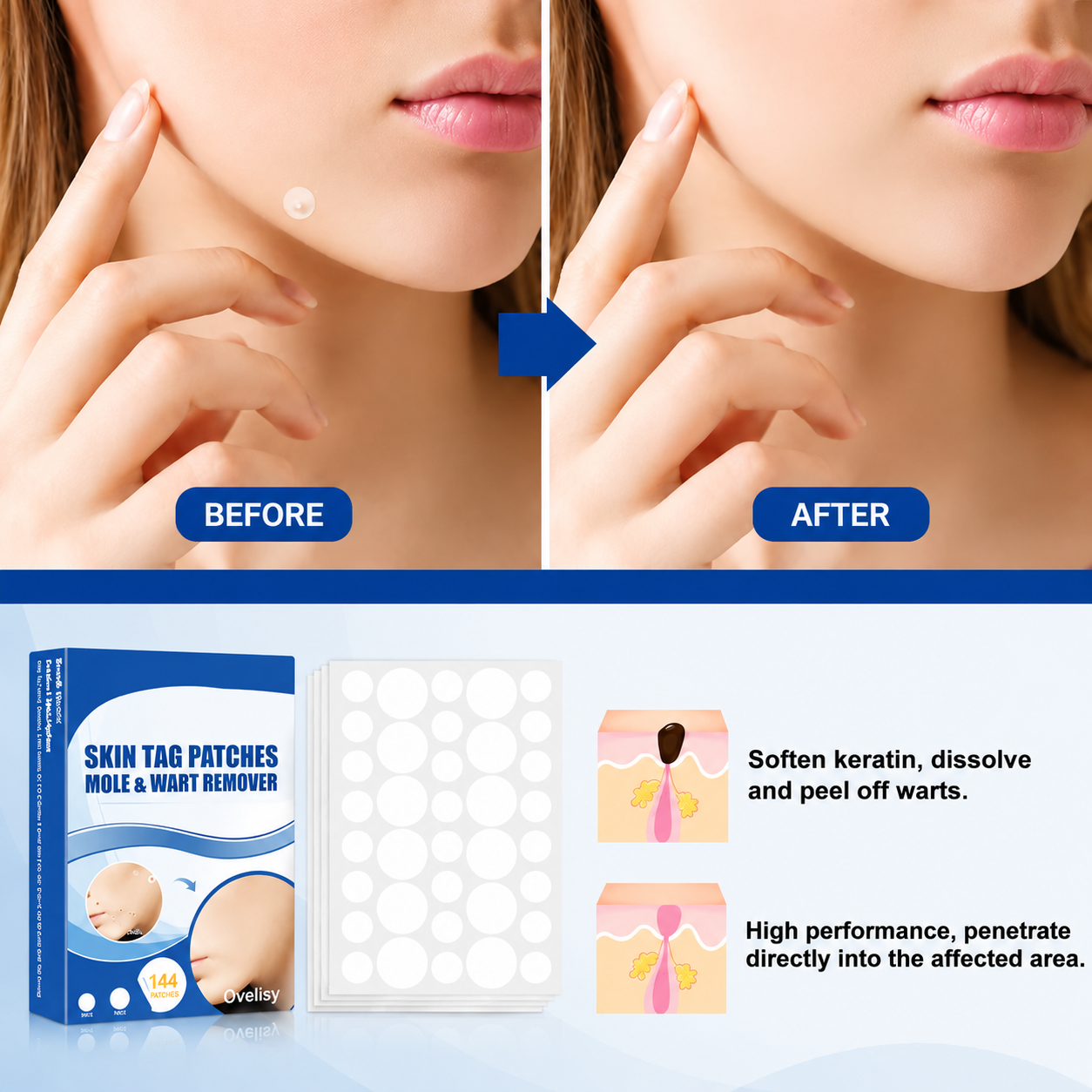 Ovelisy® Skin tag patches mole & wart remover